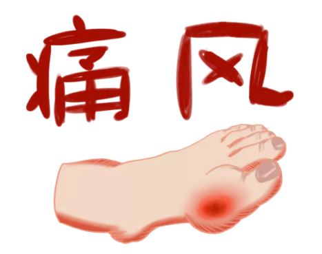 痛風