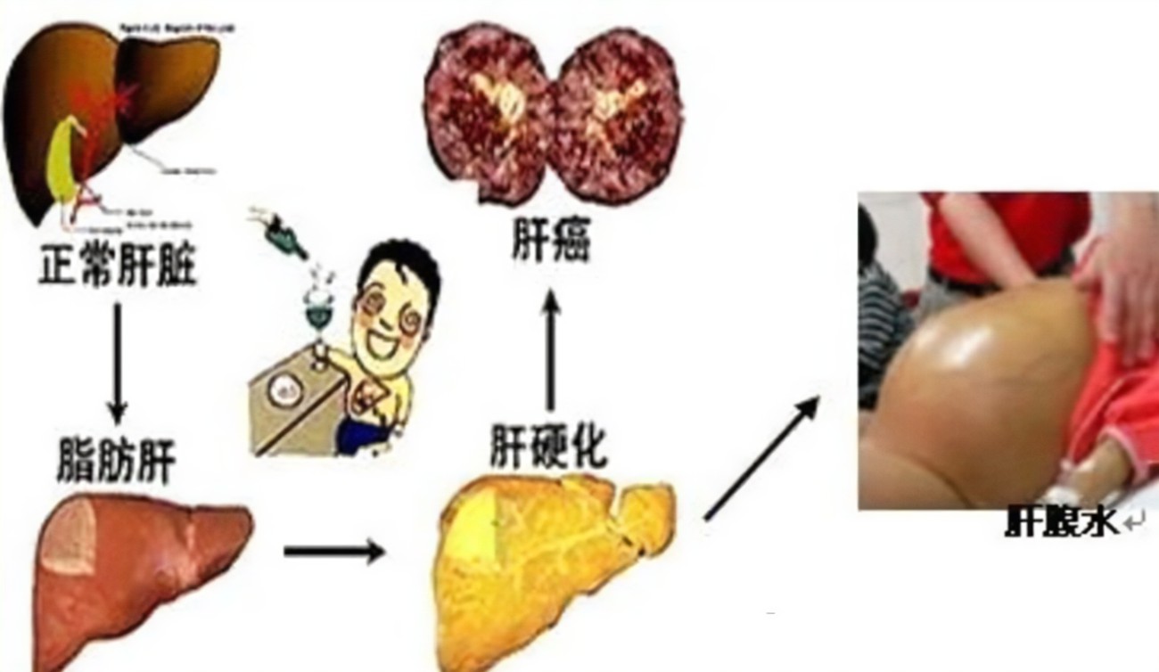 查出肝硬化還有救嗎？